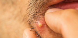 Zbog ceđenja bubuljica možete izgubiti vid, ostati paralizovani ili čak umreti