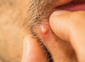 Zbog ceđenja bubuljica možete izgubiti vid, ostati paralizovani ili čak umreti